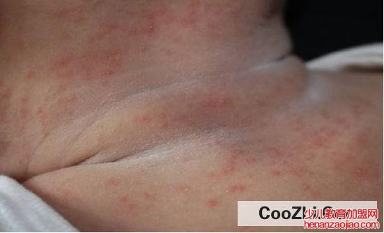 收藏冰块的日常妙用有哪些