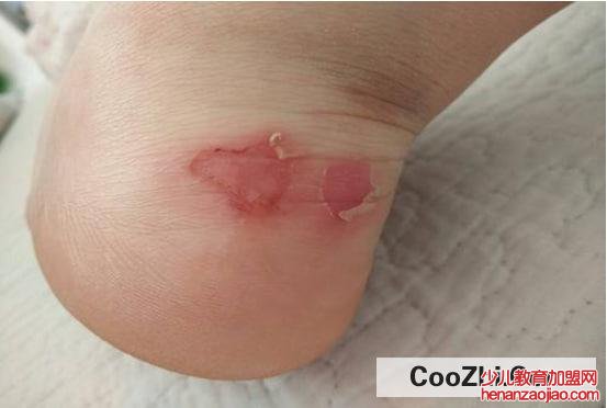 新鞋子前面磨脚的小妙招
