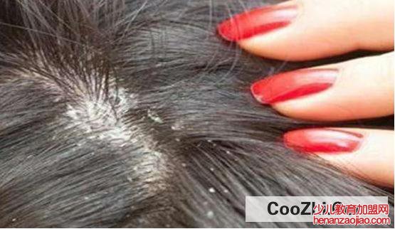 头上长虱子怎么去除