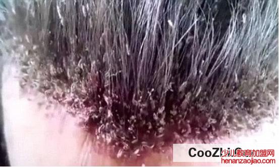 头上长虱子怎么去除