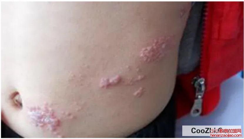 怎么诊断带状疱疹？