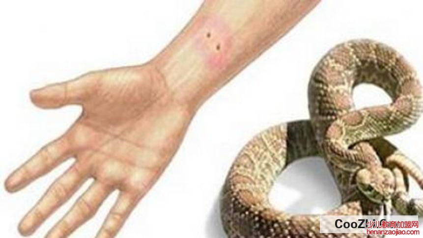 被蛇咬伤后如何紧急自救