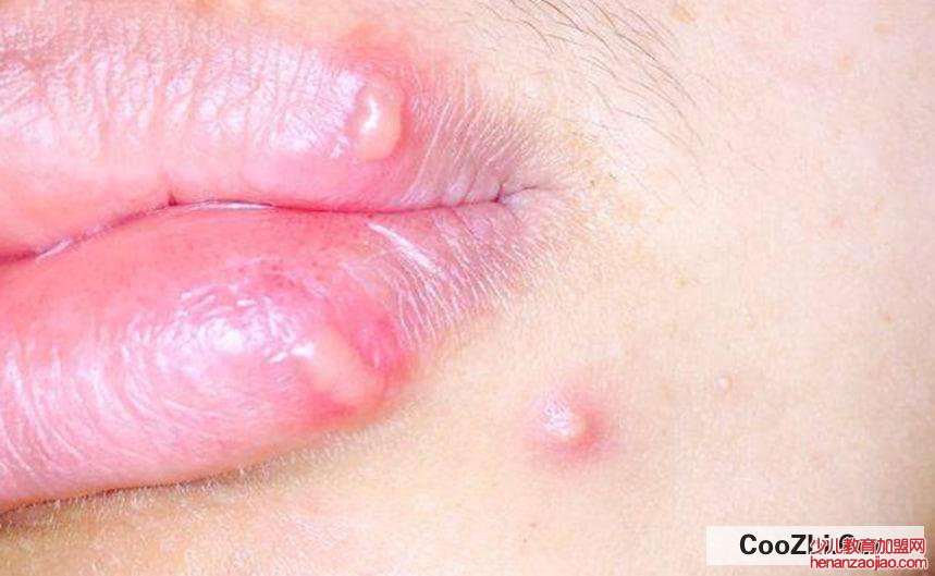 嘴上疱疹有脓能挤么
