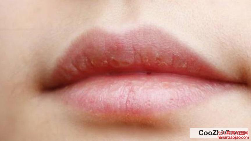 嘴唇上起皮怎么办？