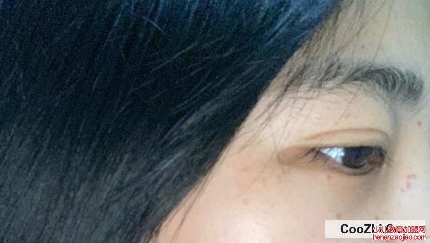 点痣后的注意事项有哪些?