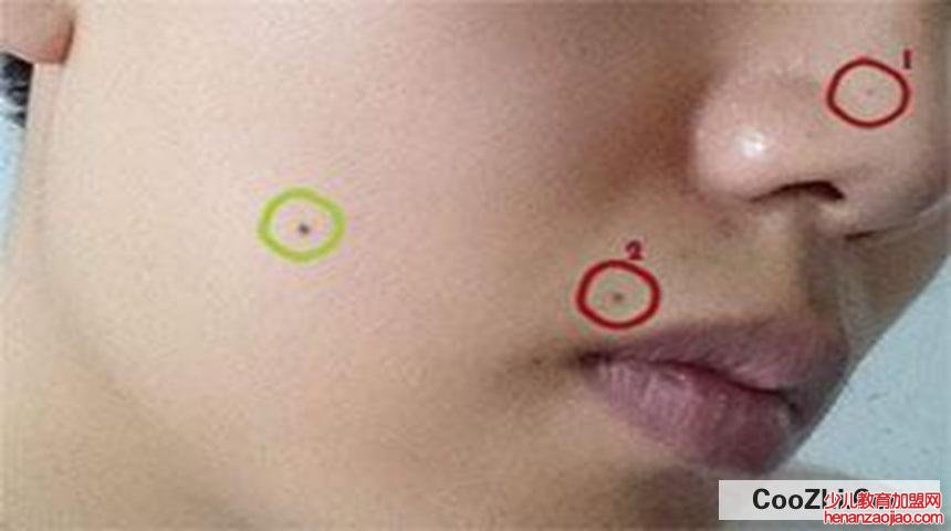 点痣后的注意事项有哪些?