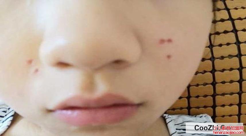 点痣后的注意事项有哪些?