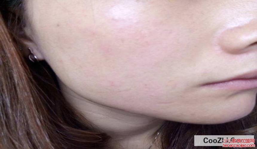 脸上过敏怎么办?