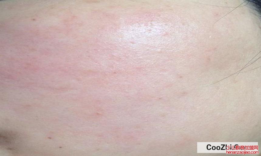 脸上过敏怎么办?