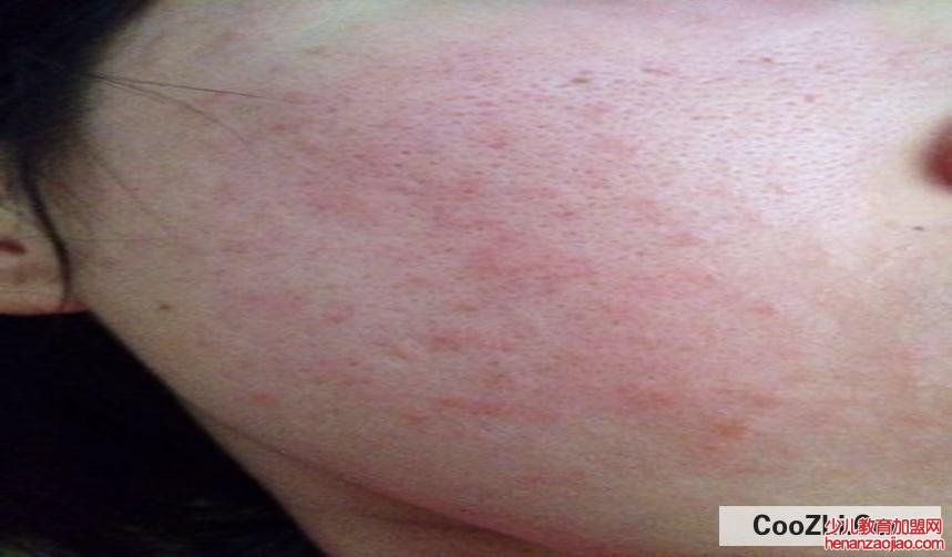 脸上过敏怎么办?