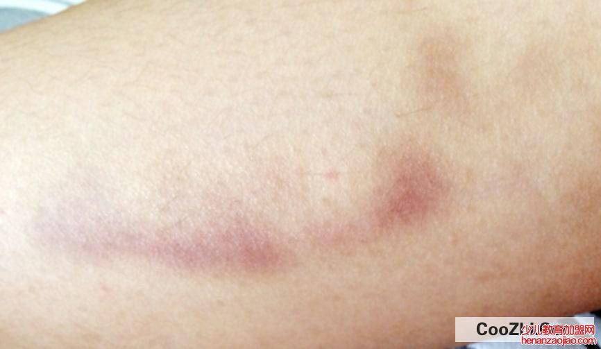 身上总是青一块紫一块什么原因