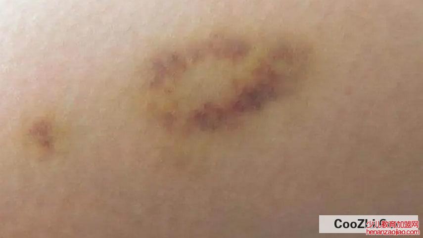 身上总是青一块紫一块什么原因
