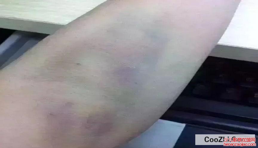 身上总是青一块紫一块什么原因