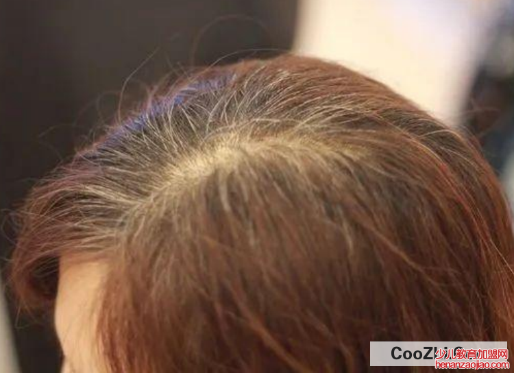 白发太多不想染发怎么办