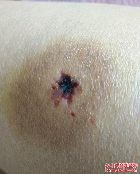 假如被狗咬了应该怎么办