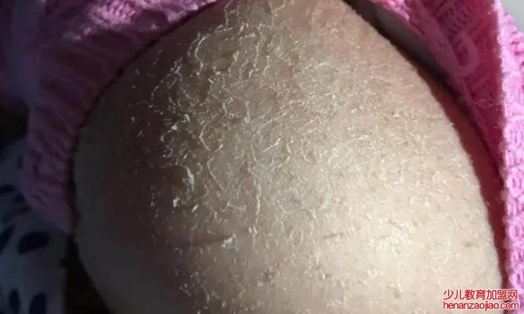 皮肤出现干燥是什么原因？