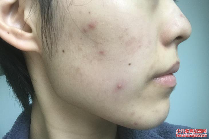 脸上出现了不少粉刺，该怎么办？